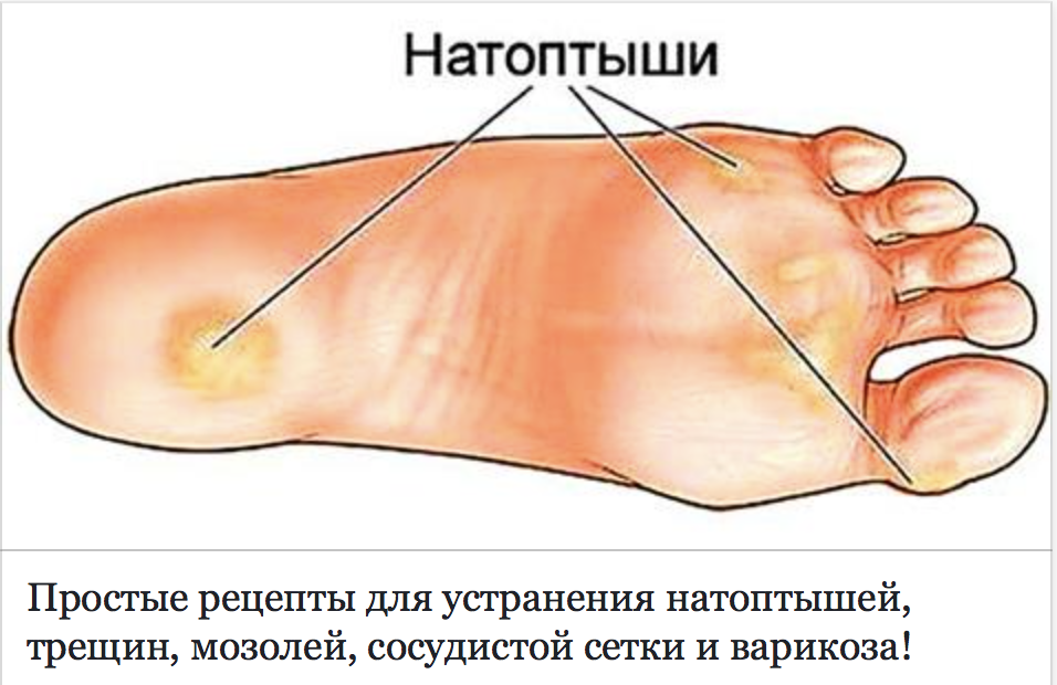 Красные кровавые мозоли на ногах: как и чем лечить, фото