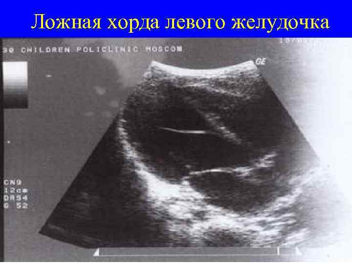 Трабекула левого желудочка: признаки, сиптомы, лечение