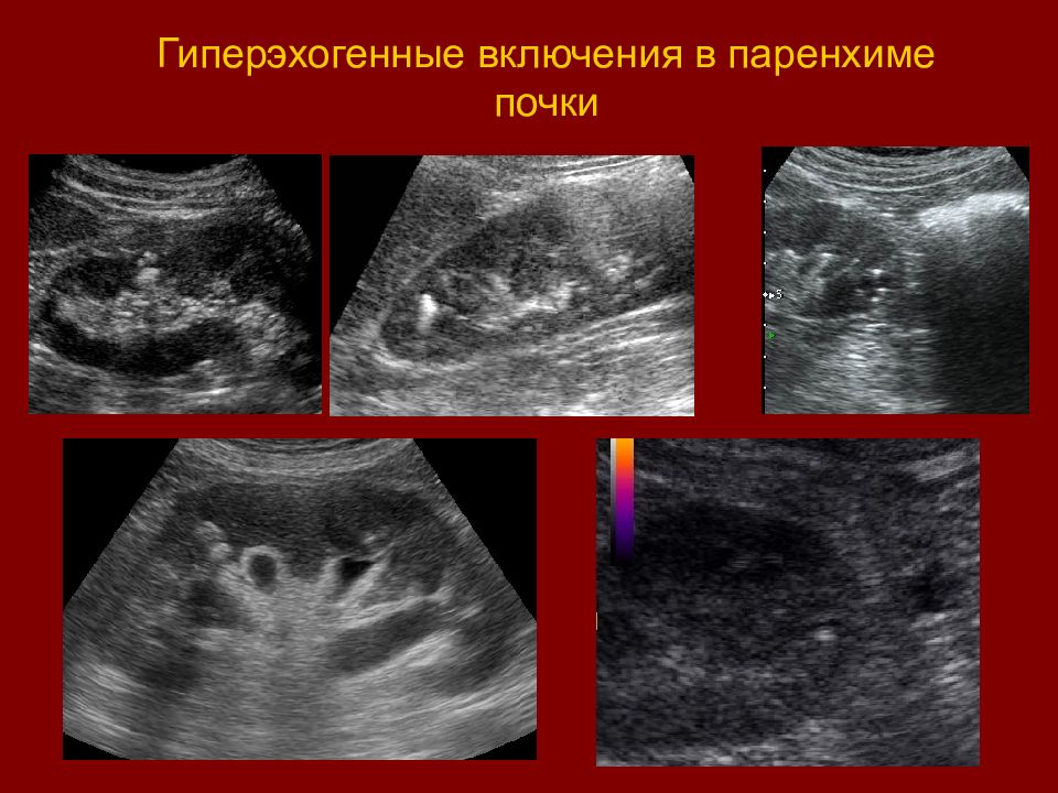 Что значит аваскулярное образование | болезнь паркинсона