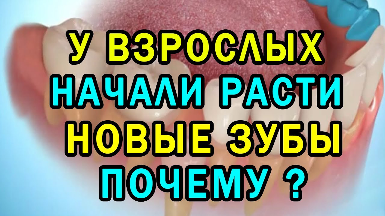 Сверхкомплектные зубы