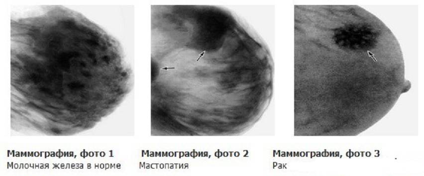 Маммография - метод ранней диагностики рака молочной железы  - бу «канашский ммц» минздрава чувашии