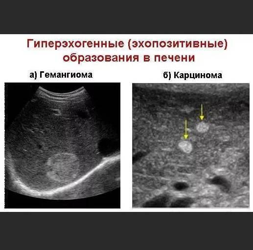 Характеристики аваскулярного образования в молочной железе