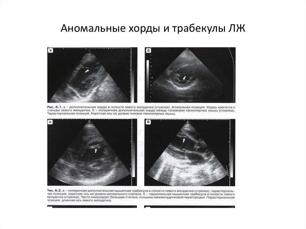 Дефект межжелудочковой перегородки сердца