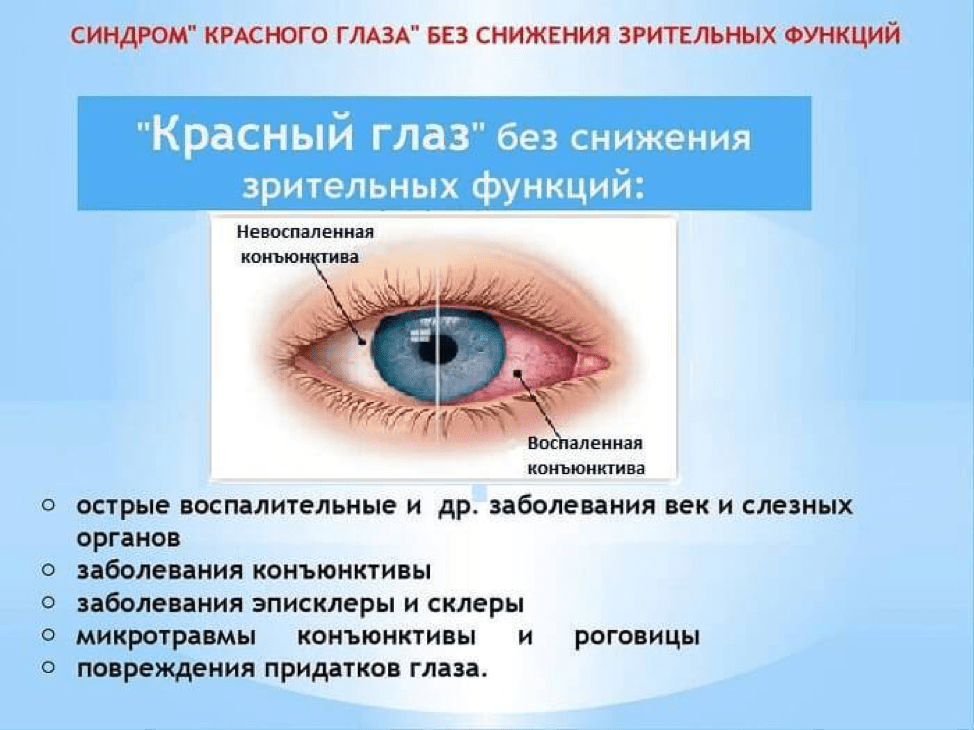 Жжение в глазах: причины, лечение, сопутствующие симптомы (песок в глазах, печет, слезотечение, резь, боль, зуд), народные средства