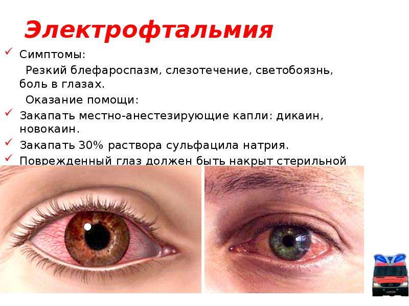 Глаз покраснел и слезится: что делать в домашних условиях, если недуг появился у взрослого